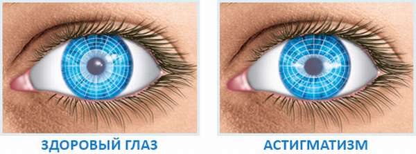 отличия здорового глаза и больного астигматизмом